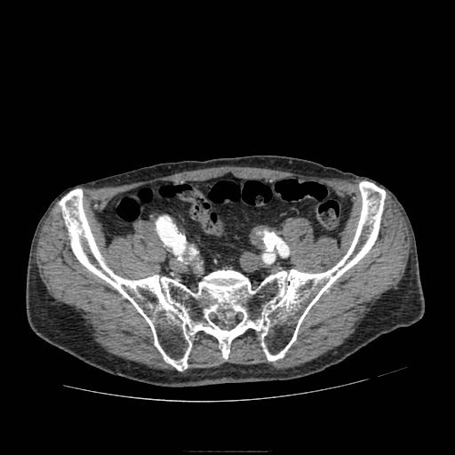 Abdominal aortic aneurysm (Radiopaedia 13341-13340 Axial C+ arterial phase 189).jpg