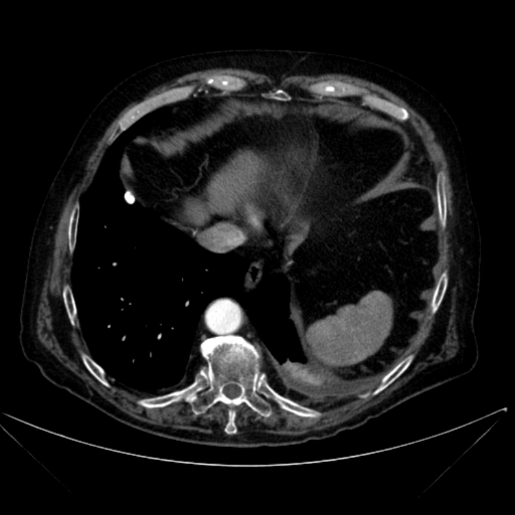 Abdominal aortic aneurysm (Radiopaedia 25855-26001 Axial C+ arterial phase 19).jpg