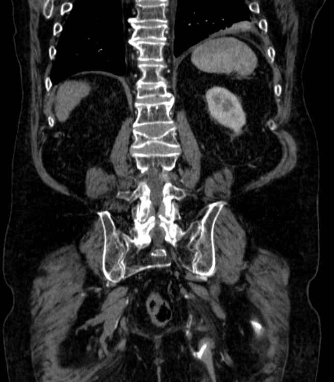 Abdominal aortic aneurysm (Radiopaedia 25855-26001 Coronal C+ arterial phase 60).jpg