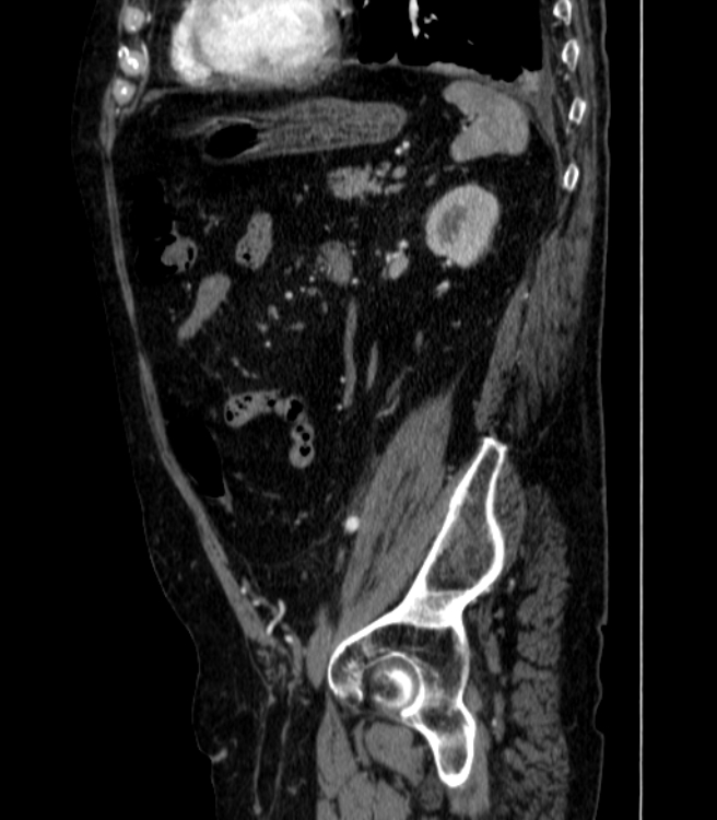 Abdominal aortic aneurysm (Radiopaedia 25855-26001 Sagittal C+ arterial phase 52).jpg