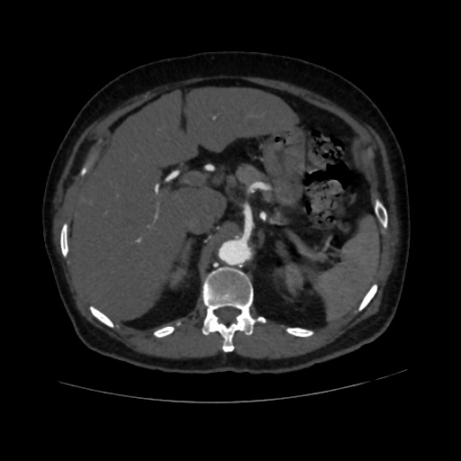 File:Abdominal aortic aneurysm (Radiopaedia 57318-64259 Axial C+ arterial phase 19).jpg