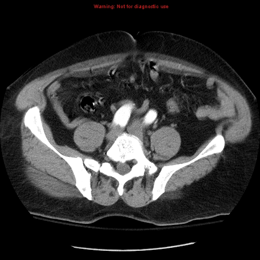 File:Abdominal aortic aneurysm (Radiopaedia 8190-9038 Axial C+ arterial phase 57).jpg
