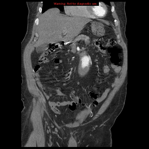 Abdominal aortic aneurysm (Radiopaedia 8190-9038 Coronal C+ arterial phase 37).jpg