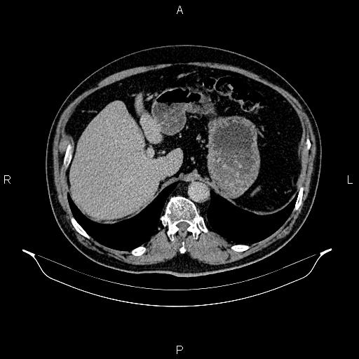Abdominal aortic aneurysm (Radiopaedia 83094-97462 Axial renal excretory phase 28).jpg
