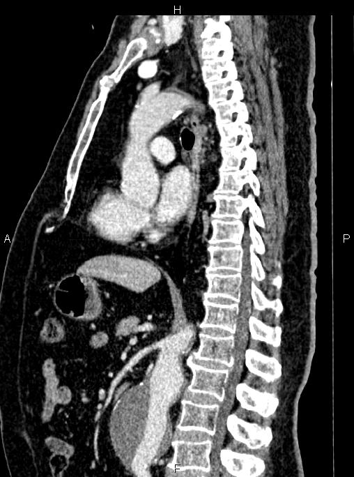 Abdominal aortic aneurysm (Radiopaedia 83094-97462 Sagittal renal cortical phase 66).jpg