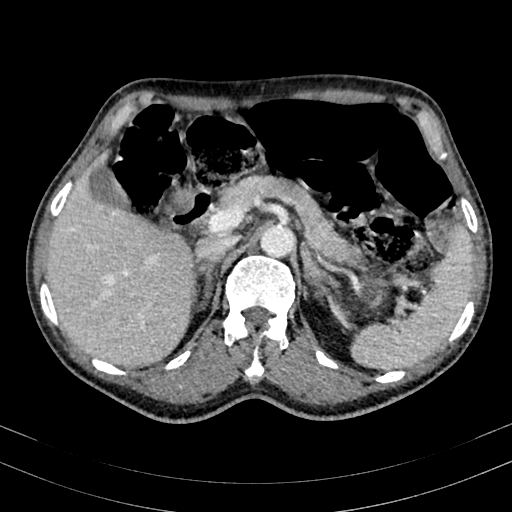 Abdominal aortic aneurysm (Radiopaedia 83581-98689 Axial C+ portal venous phase 33).jpg