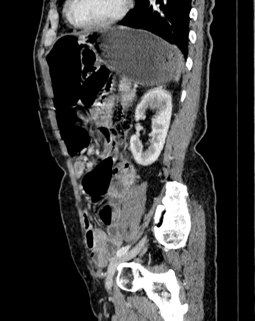 Abdominal aortic aneurysm (Radiopaedia 83581-98689 Sagittal C+ portal venous phase 93).jpg