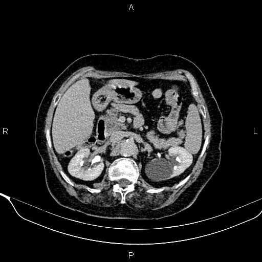 Abdominal aortic aneurysm (Radiopaedia 85063-100606 Axial C+ delayed 31).jpg