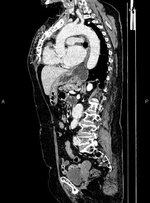 Abdominal aortic aneurysm (Radiopaedia 85063-100606 Sagittal C+ arterial phase 47).jpg
