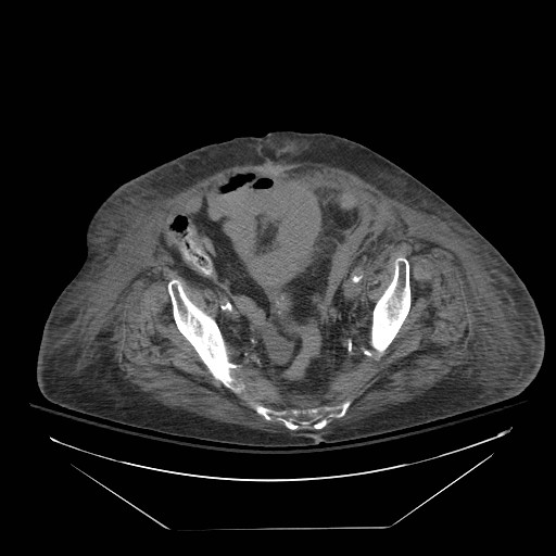 Abdominal aortic aneurysm - impending rupture (Radiopaedia 19233-19247 Axial non-contrast 137).jpg