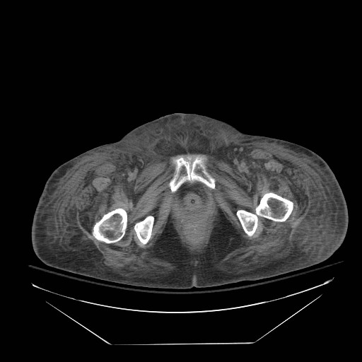 File:Abdominal aortic aneurysm - impending rupture (Radiopaedia 19233-19247 Axial non-contrast 169).jpg