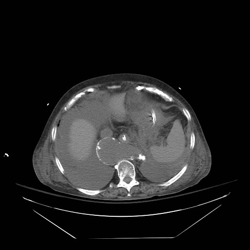 Abdominal aortic aneurysm - impending rupture (Radiopaedia 19233-19247 Axial non-contrast 33).jpg