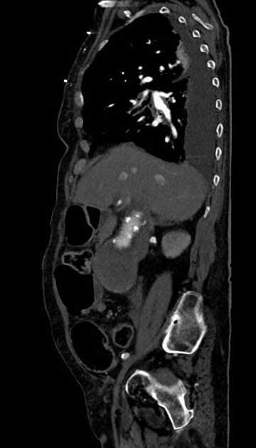 Abdominal aortic aneurysm with thrombus fissuration (Radiopaedia 73192-83919 Sagittal C+ arterial phase 97).jpg