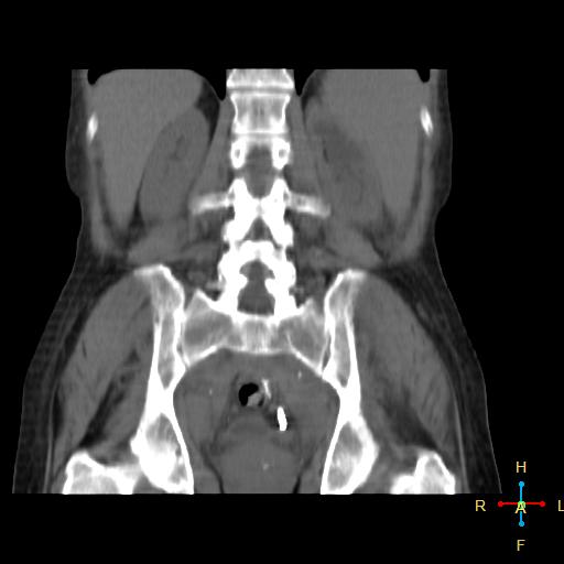 File:Abdominal lymphoma (Radiopaedia 23085-23115 Coronal non-contrast 4).jpg