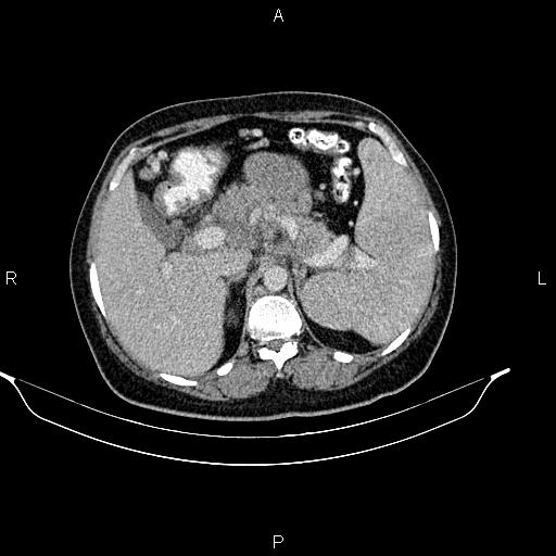 File:Abdominal lymphoma with sandwich sign (Radiopaedia 84378-99704 Axial C+ portal venous phase 16).jpg
