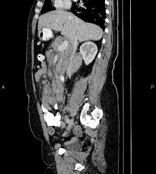 Abdominal lymphoma with sandwich sign (Radiopaedia 84378-99704 Sagittal C+ portal venous phase 33).jpg