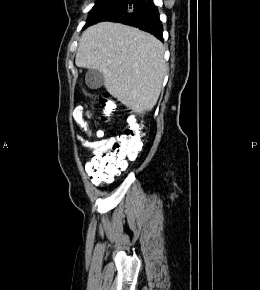 Abdominal lymphoma with sandwich sign (Radiopaedia 84378-99704 Sagittal C+ portal venous phase 8).jpg