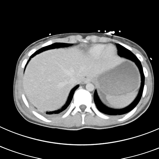 File:Abdominal multi-trauma - devascularised kidney and liver, spleen and pancreatic lacerations (Radiopaedia 34984-36486 Axial C+ delayed 7).png