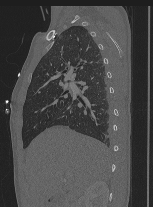 Abdominal multi-trauma - devascularised kidney and liver, spleen and pancreatic lacerations (Radiopaedia 34984-36486 Sagittal bone window 64).png