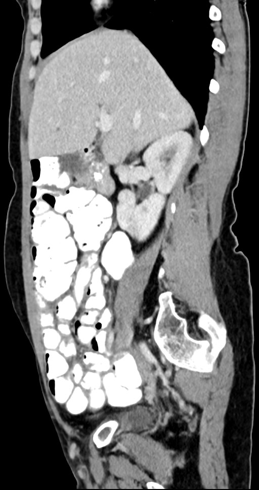 Abdominal wall and retroperitoneal tuberculosis (Radiopaedia 88137-104729 Sagittal C+ portal venous phase 97).jpg