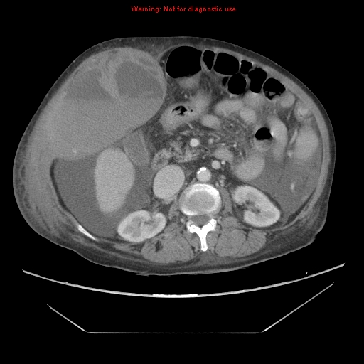 File:Abdominal wall hematoma (Radiopaedia 9427-10112 Axial C+ portal venous phase 44).jpg