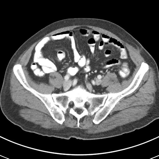 File:Abdominal wall metastasis from colorectal carcinoma (Radiopaedia 31016-31717 Axial C+ portal venous phase 56).jpg