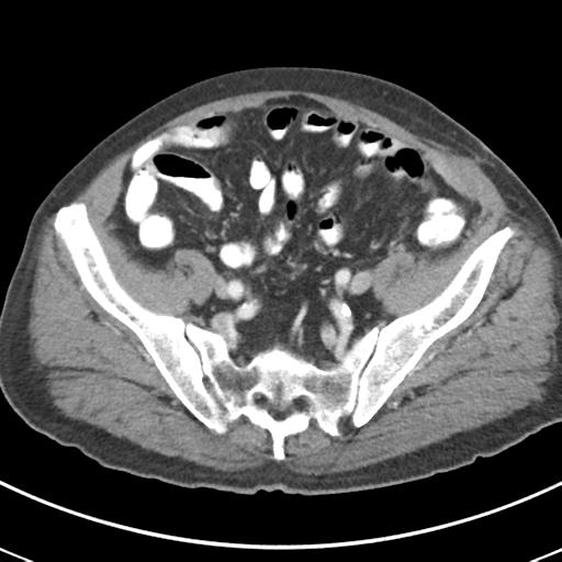File:Abdominal wall metastasis from colorectal carcinoma (Radiopaedia 31016-31717 Axial C+ portal venous phase 59).jpg