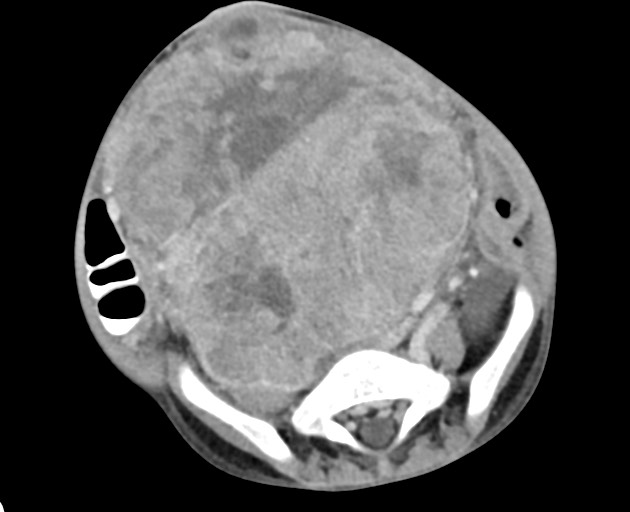 Abdominopelvic rhabdomyosarcoma (Radiopaedia 78356-90984 Axial C+ portal venous phase 117).jpg