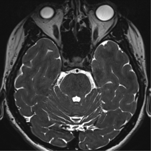 File:Abducens nerve palsy (Radiopaedia 51069-56648 Axial T2 fat sat 43).png