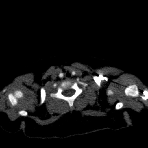 Aberrant left pulmonary artery (pulmonary sling) (Radiopaedia 42323-45435 Axial C+ CTPA 2).jpg