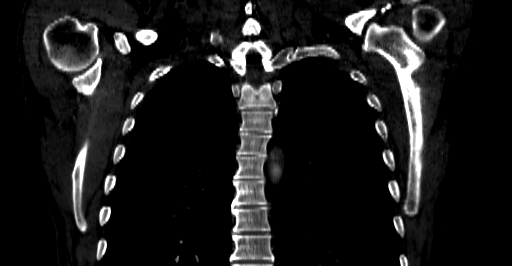 Accesory rib joint (Radiopaedia 71987-82452 Coronal bone window 33).jpg