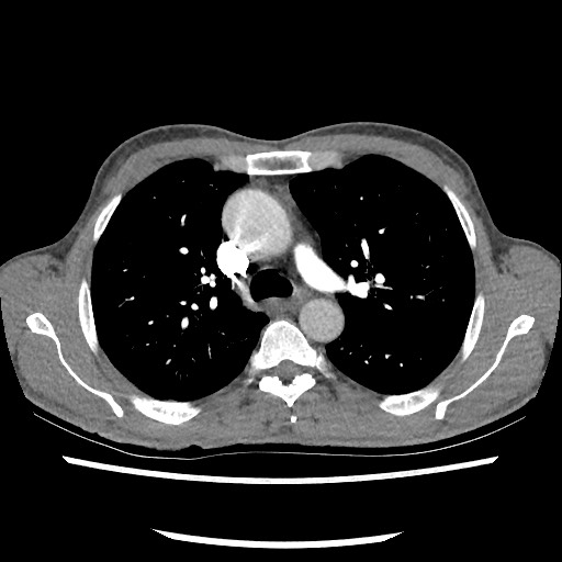 Accessory left horizontal fissure with lingular pneumonia (Radiopaedia 53763-59843 Axial C+ CTPA 36).jpg