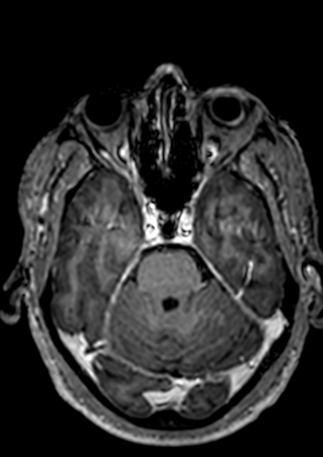 File:Accessory middle cerebral artery (Radiopaedia 73114-83828 Axial T1 C+ 103).jpg