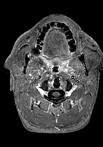 Accessory middle cerebral artery (Radiopaedia 73114-83828 Axial T1 C+ 228).jpg
