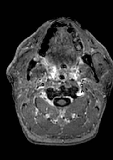 File:Accessory middle cerebral artery (Radiopaedia 73114-83828 Axial T1 C+ 248).jpg