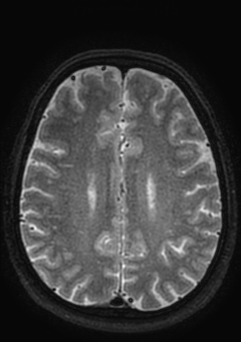 Accessory middle cerebral artery (Radiopaedia 73114-83828 Axial T2 8).jpg