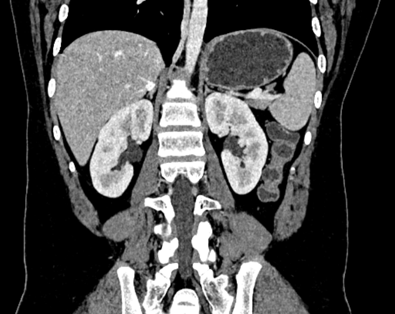 Accessory right inferior hepatic vein (Radiopaedia 75207-86305 Coronal C+ portal venous phase 48).jpg