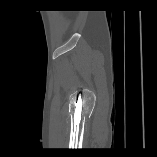 Acetabular and ilial fractures (Radiopaedia 59084-66378 Sagittal bone window 91).jpg
