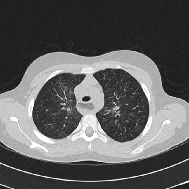 Achalasia (Radiopaedia 14946-14878 Axial lung window 18).jpg