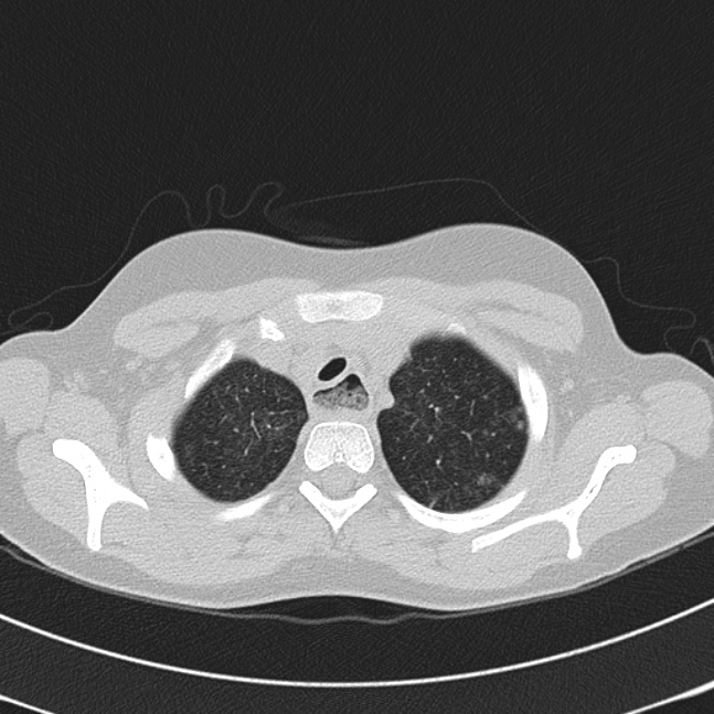 Achalasia (Radiopaedia 14946-14878 Axial lung window 8).jpg