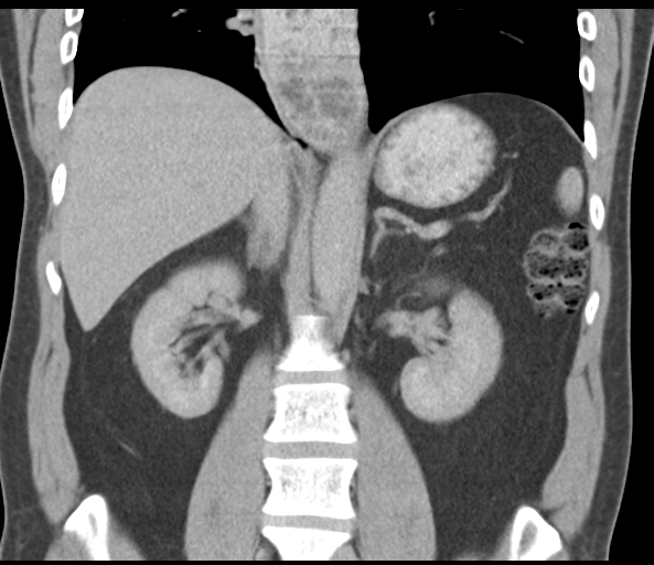 File:Achalasia of the cardia (Radiopaedia 38497-40595 Coronal C+ portal venous phase 31).png