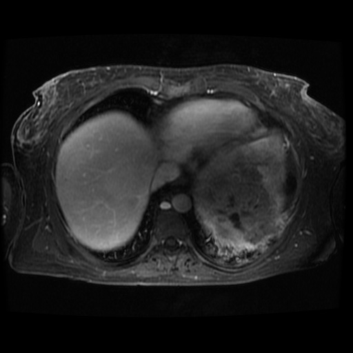 Acinar cell carcinoma of the pancreas (Radiopaedia 75442-86668 D 130).jpg