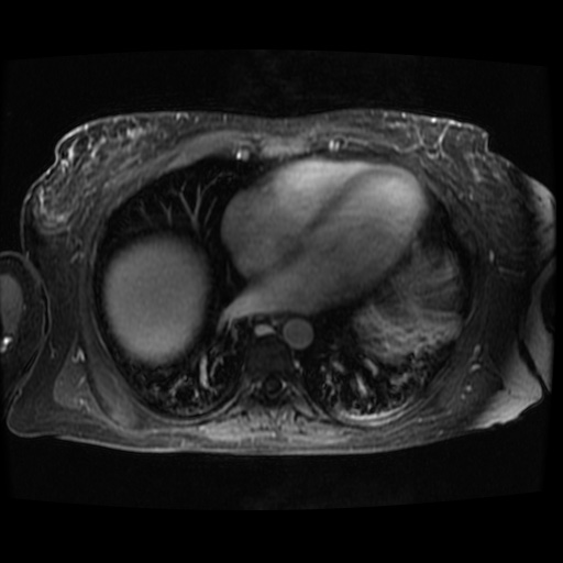 Acinar cell carcinoma of the pancreas (Radiopaedia 75442-86668 D 142).jpg