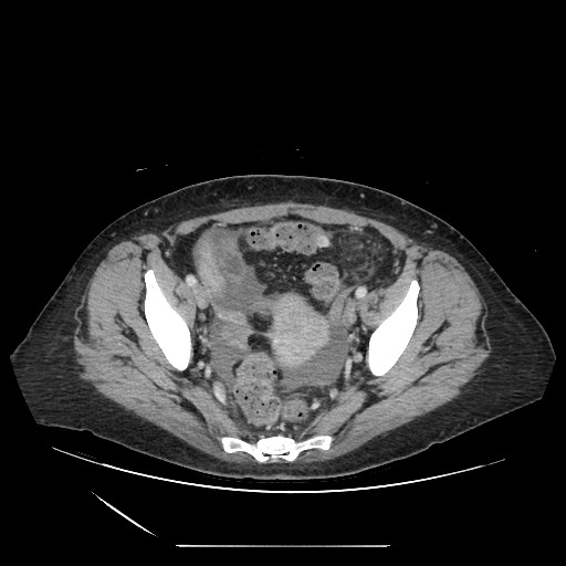 Acinar cell carcinoma of the pancreas (Radiopaedia 75442-86669 Axial C+ portal venous phase 125).jpg
