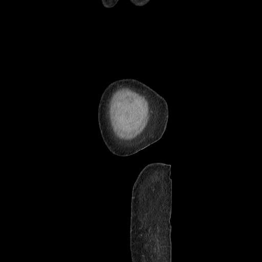 File:Acinar cell carcinoma of the pancreas (Radiopaedia 75442-86669 Sagittal C+ portal venous phase 191).jpg