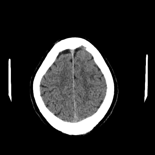 File:Acoustic schwannoma (Radiopaedia 55729-62280 Axial non-contrast 28).png