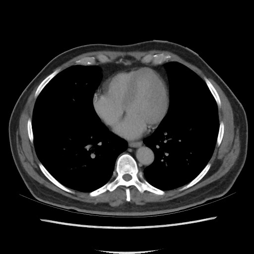 File:Active colonic bleed on CT (Radiopaedia 49765-55025 Axial C+ delayed 1).jpg