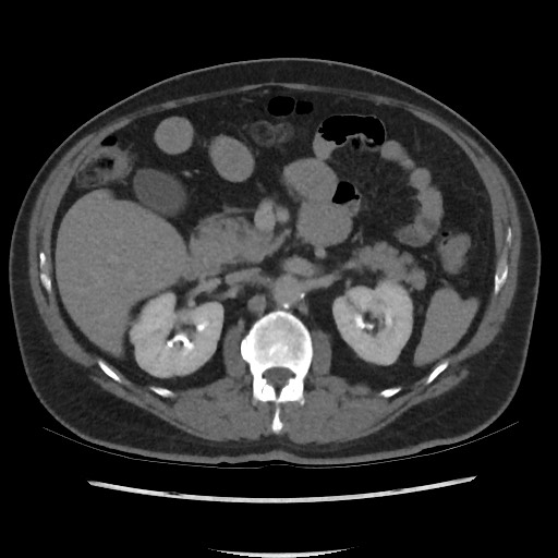 File:Active colonic bleed on CT (Radiopaedia 49765-55025 Axial C+ delayed 31).jpg