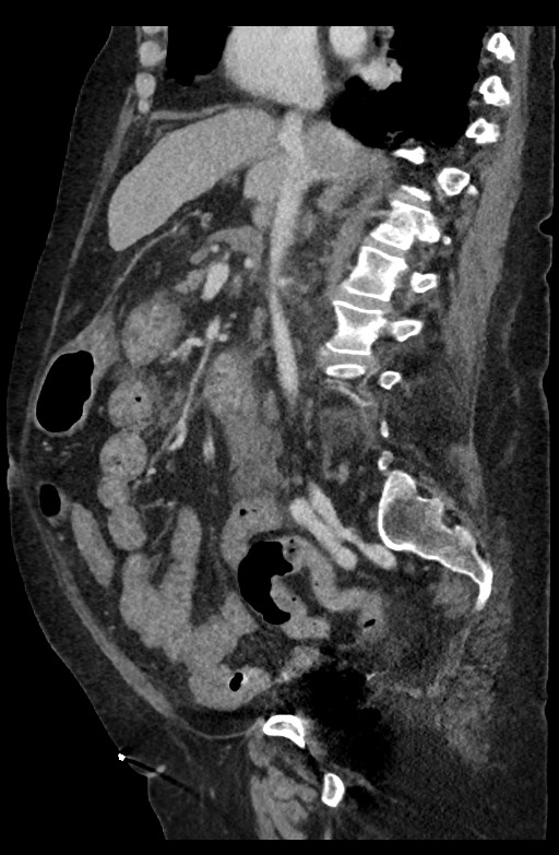 Active renal extravasation with large subcapsular and retroperitoneal hemorrhage (Radiopaedia 60975-68796 Sagittal C+ portal venous phase 131).jpg