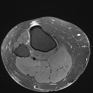 File:Acute-on-chronic transient lateral patellar dislocation with trochlear dysplasia (Radiopaedia 84099-99349 Axial PD fat sat 35).jpg